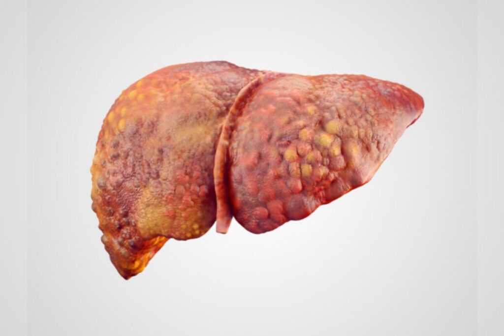gordura-no-figado:-estudo-explica-desenvolvimento-em-pessoas-magras