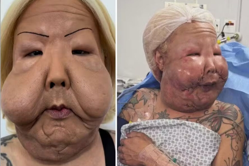 juju-do-pix-mostra-como-ficou-o-rosto-um-mes-apos-retirar-oleo-mineral