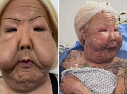 juju-do-pix-mostra-como-ficou-o-rosto-um-mes-apos-retirar-oleo-mineral