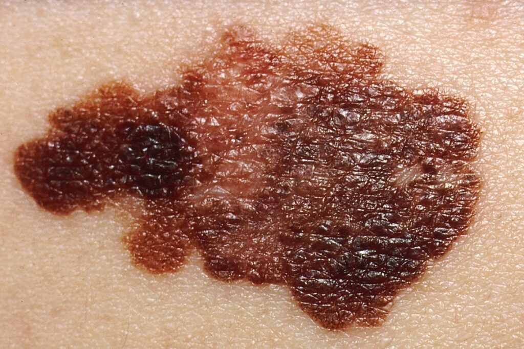 cancer-de-pele:-dermatologista-diz-como-identificar-sinais-suspeitos