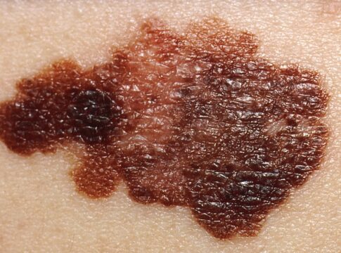 cancer-de-pele:-dermatologista-diz-como-identificar-sinais-suspeitos