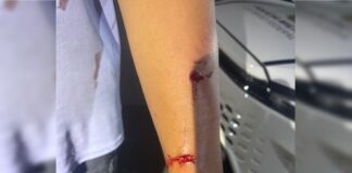 veja-como-ficaram-crianca-e-policial-atacados-por-pit-bulls-no-df