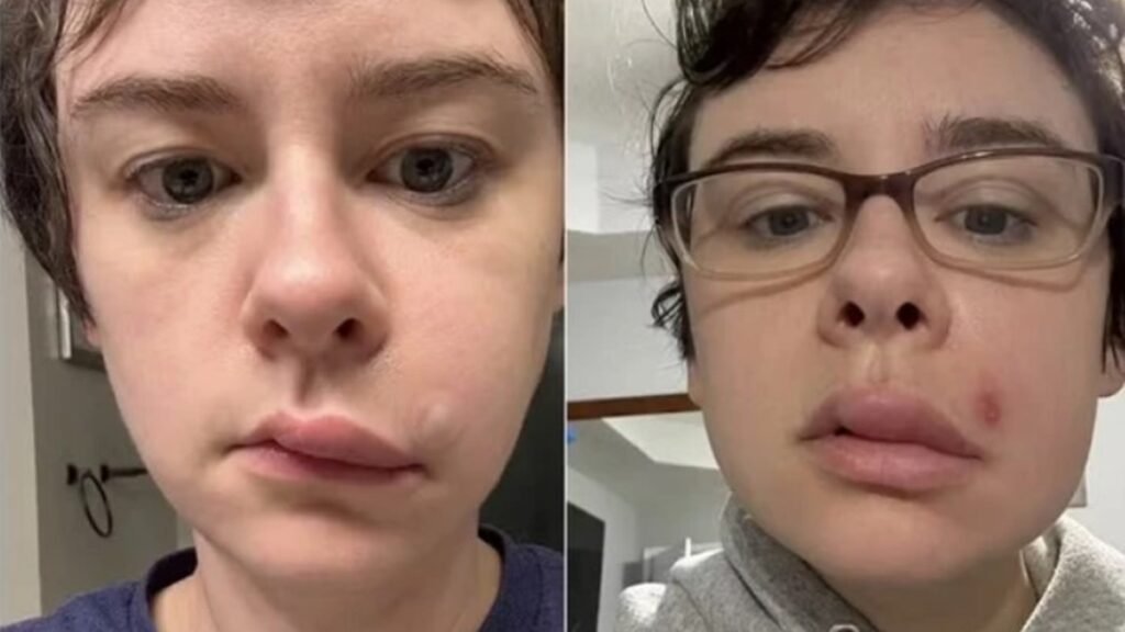 jovem-para-no-hospital-apos-espremer-espinha-no-“triangulo-da-morte”