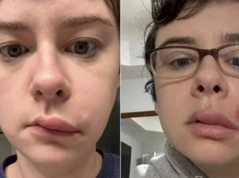 jovem-para-no-hospital-apos-espremer-espinha-no-“triangulo-da-morte”