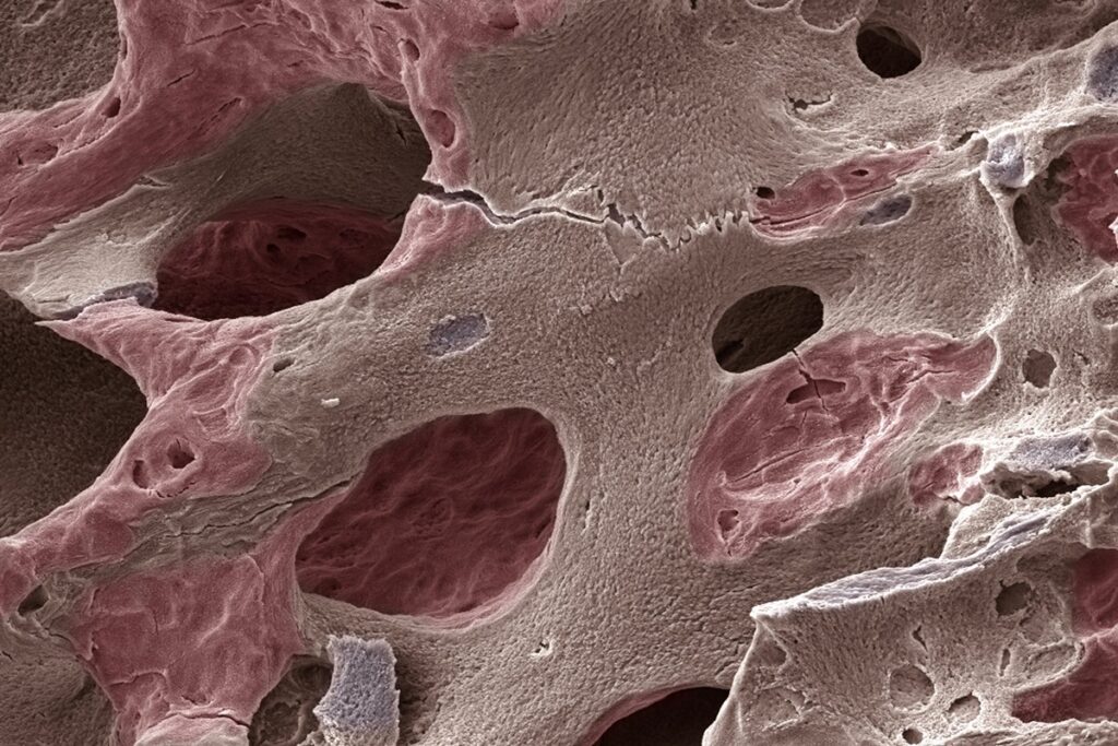 casos-de-osteoporose-devem-disparar-ate-2050,-inclusive-no-brasil