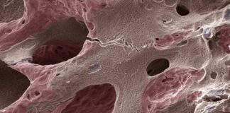 casos-de-osteoporose-devem-disparar-ate-2050,-inclusive-no-brasil