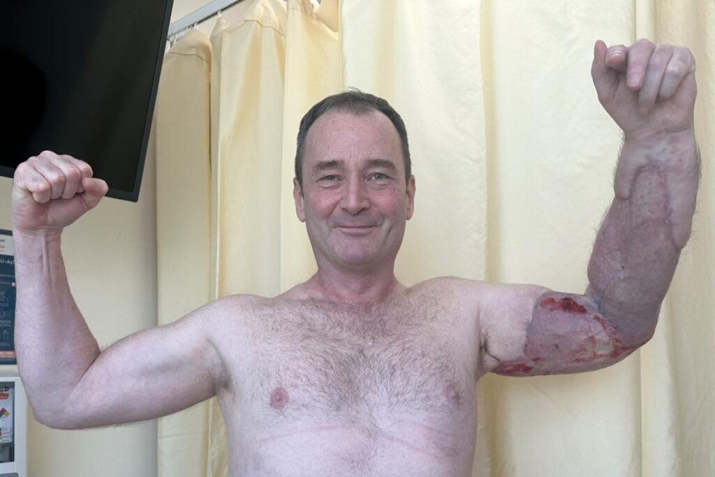 homem-quase-perde-o-braco-por-bacteria-apos-se-machucar-na-academia