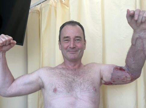 homem-quase-perde-o-braco-por-bacteria-apos-se-machucar-na-academia