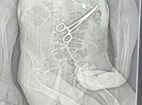 homem-morre-apos-pinca-ser-deixada-no-corpo-em-cirurgia