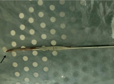 menino-senta-em-agulha-de-croche-e-gancho-torna-cirurgia-um-desafio