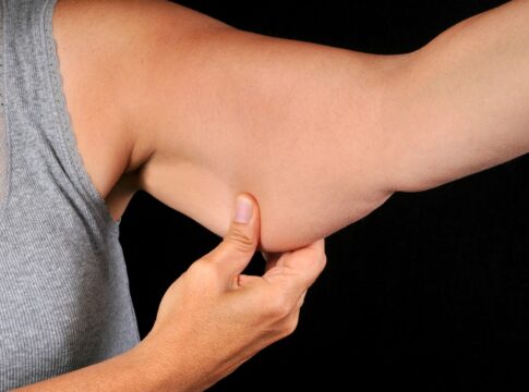 nutrologa-da-dicas-de-como-emagrecer-sem-flacidez