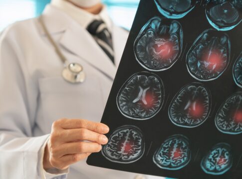 neurologista-explica-o-que-e-um-avc-e-quais-sao-os-principais-sintomas