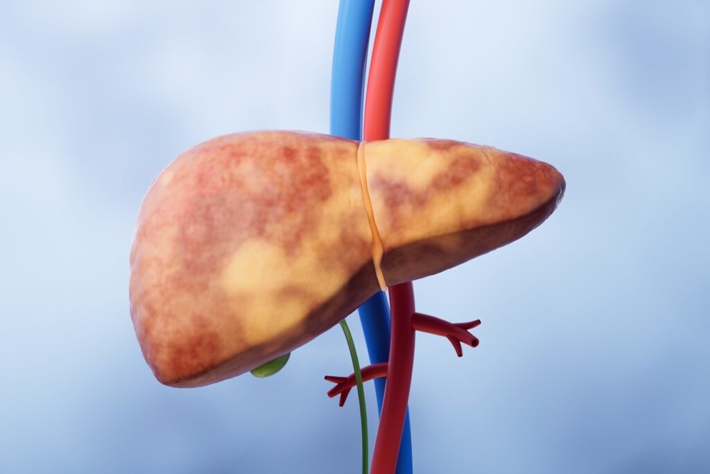 hepatologistas-citam-riscos-da-gordura-no-figado-para-a-saude-em-geral