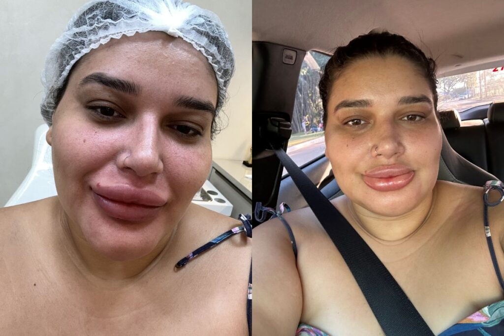 maquiadora-viraliza-com-labios-inchados-apos-remover-preenchimento