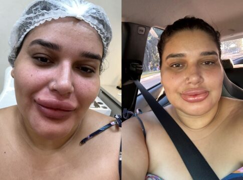 maquiadora-viraliza-com-labios-inchados-apos-remover-preenchimento