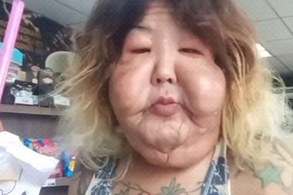 veja-o-resultado-da-cirurgia-orofacial-da-influenciadora-juju-do-pix