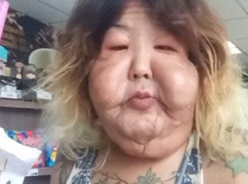 veja-o-resultado-da-cirurgia-orofacial-da-influenciadora-juju-do-pix