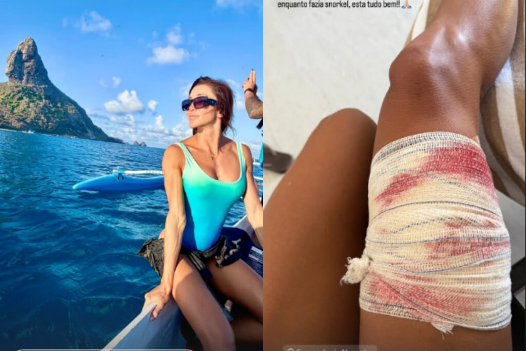 advogada-e-mordida-por-tubarao-ao-fazer-snorkel-em-fernando-de-noronha