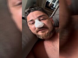 turista-agredido-em-porto-de-galinhas-corrige-4-fraturas-na-face