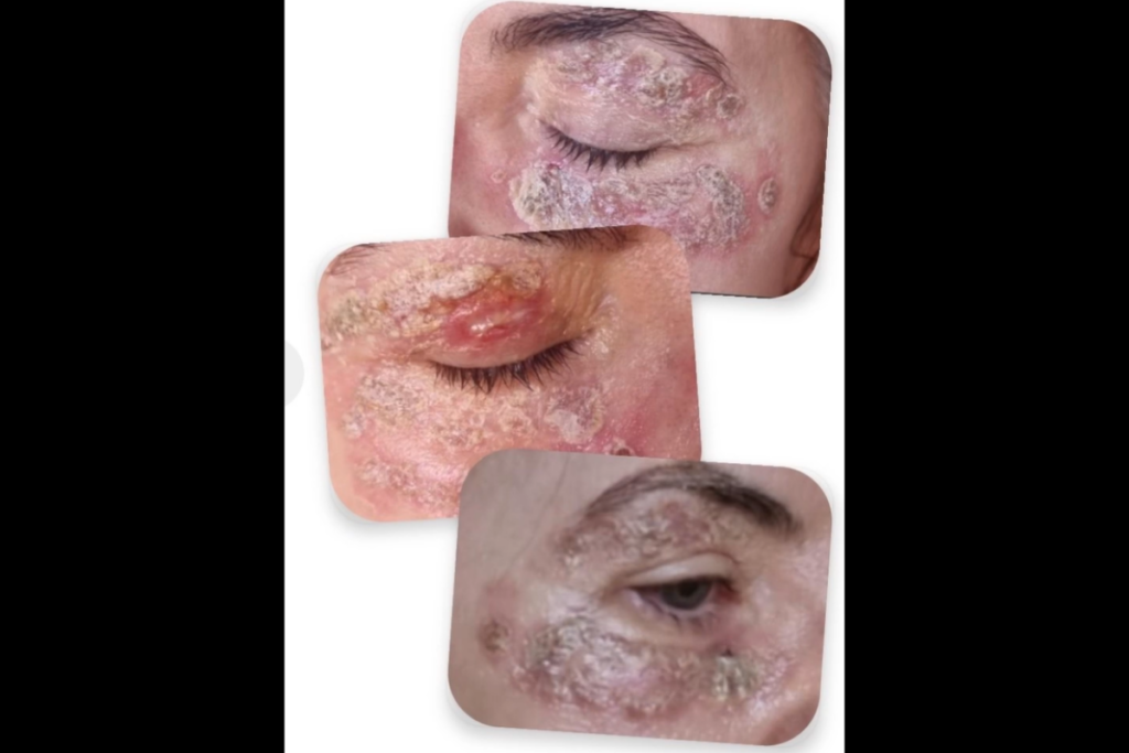 psicanalista-faz-alerta-apos-ter-rosto-queimado-por-procedimento