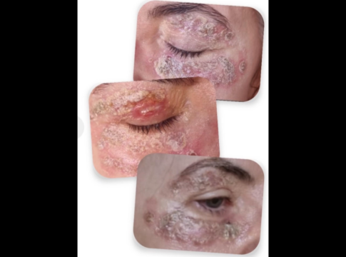 psicanalista-faz-alerta-apos-ter-rosto-queimado-por-procedimento