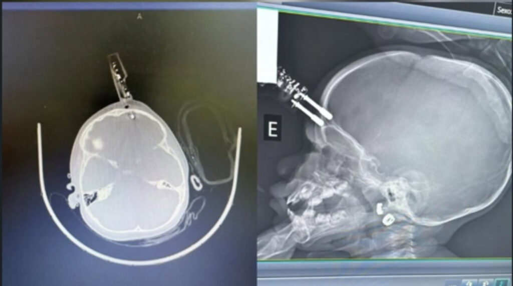 menina-que-teve-carregador-de-celular-cravado-na-testa-recebe-alta