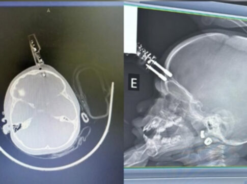 menina-que-teve-carregador-de-celular-cravado-na-testa-recebe-alta