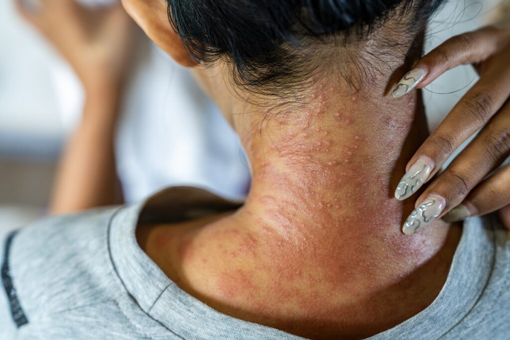 dermatilomania:-psiquiatra-cita-quando-procurar-ajuda-para-tratamento