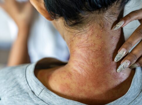 dermatilomania:-psiquiatra-cita-quando-procurar-ajuda-para-tratamento