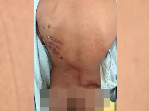 jovem-que-teve-costas-rasgadas-por-raio-em-ato-de-nikolas:-“achei-que-tinha-1h-de-vida”.-veja-video