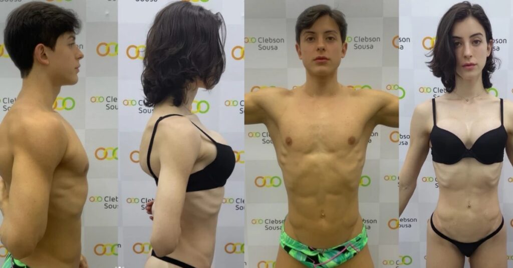 veja-o-antes-e-depois-do-procedimento-nos-gluteos-de-bella-longuinho