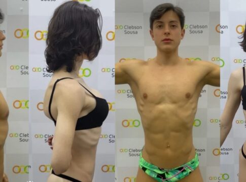 veja-o-antes-e-depois-do-procedimento-nos-gluteos-de-bella-longuinho