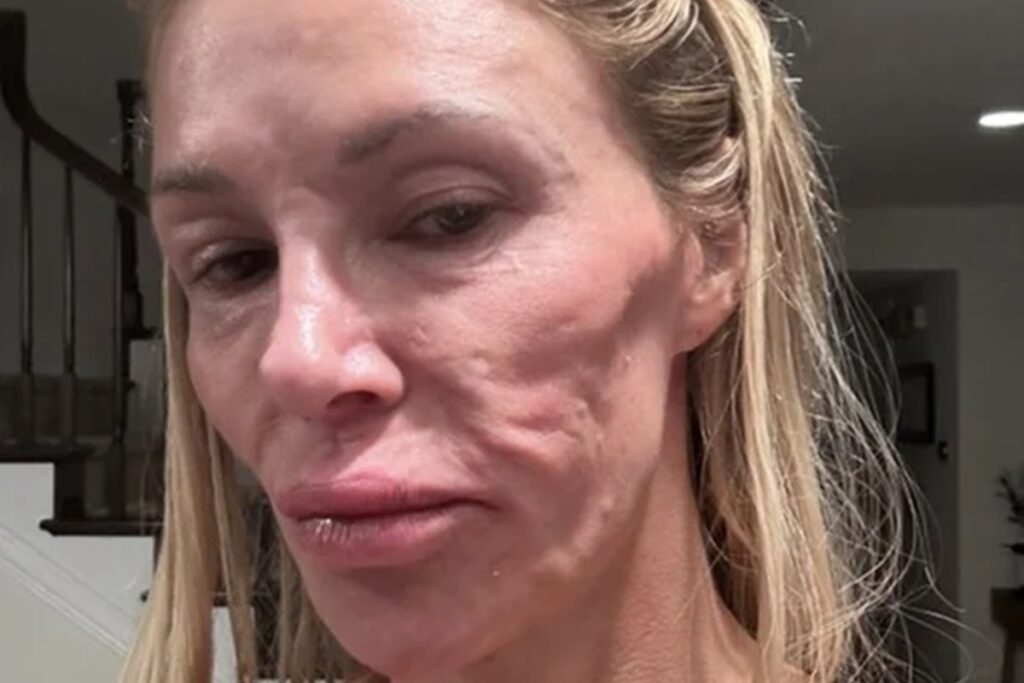influenciadora-mostra-resultado-de-cirurgia-apos-rosto-“derreter”