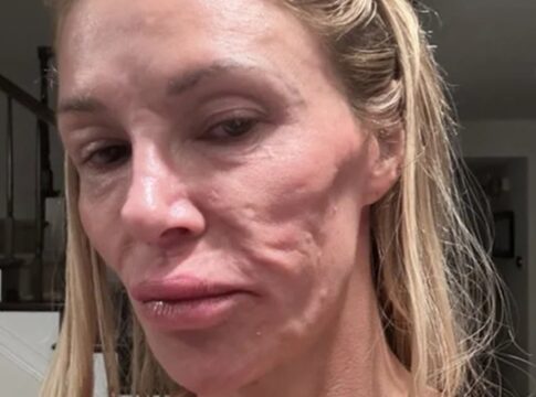 influenciadora-mostra-resultado-de-cirurgia-apos-rosto-“derreter”