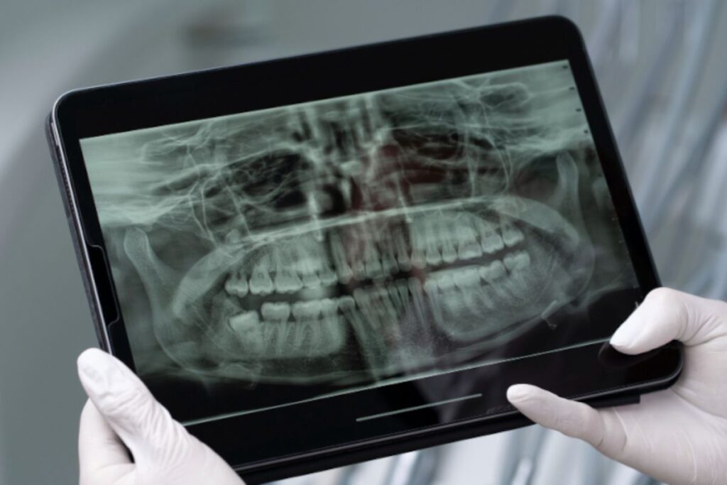 usp:-saliva-artificial-ajuda-a-proteger-dentes-de-pacientes-com-cancer