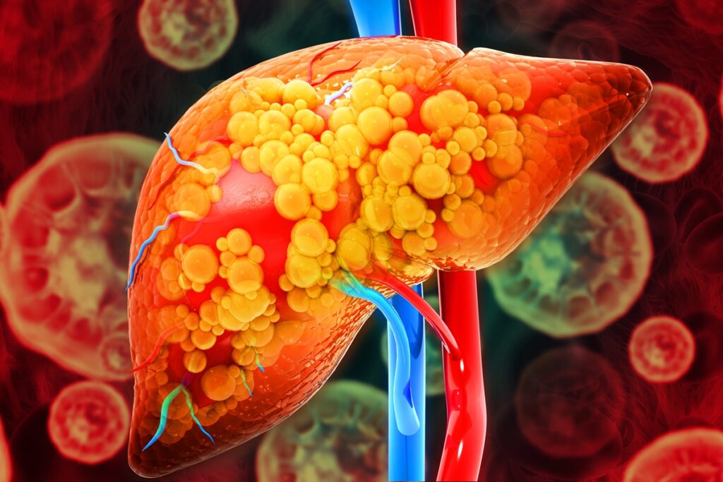 hepatologista-lista-os-6-principais-sintomas-de-gordura-no-figado