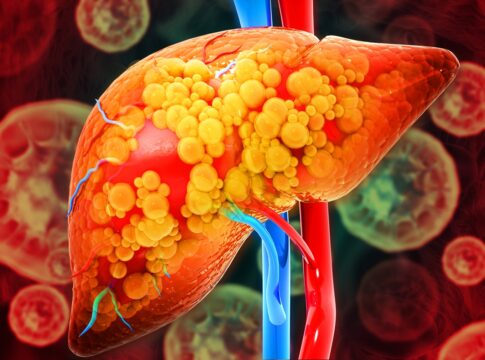 hepatologista-lista-os-6-principais-sintomas-de-gordura-no-figado