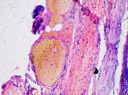 oms-aponta-quais-habitos-comuns-mais-influenciam-o-risco-de-cancer