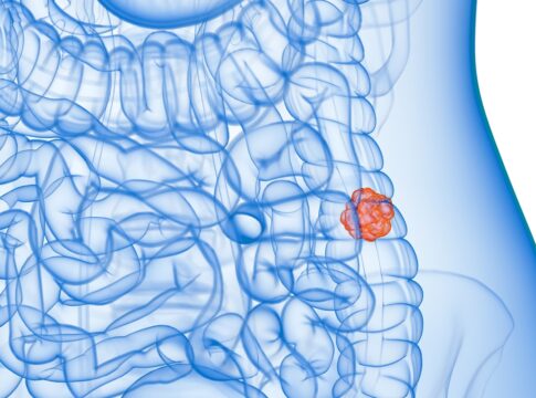 transcriptomica-espacial: abordagem-estuda-local-onde-surge-o-cancer