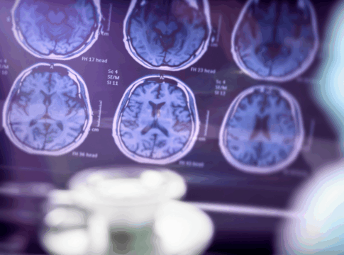 neurologista-explica-quais-sao-os-sinais-do-inicio-do-alzheimer