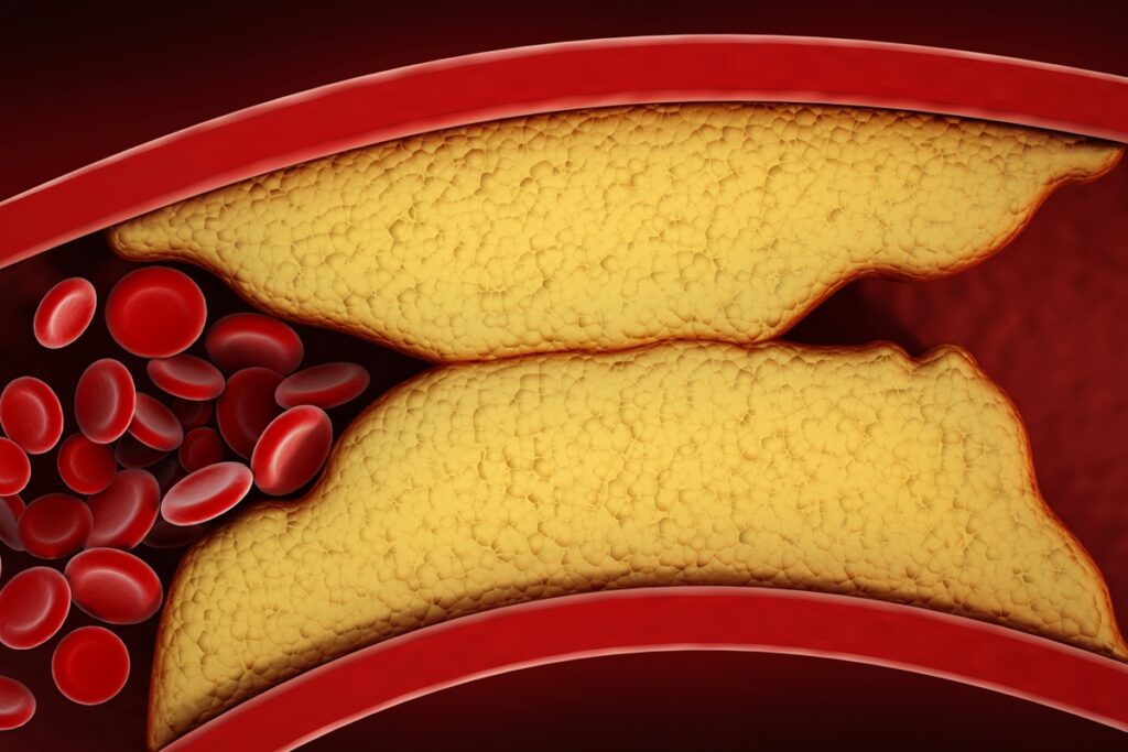 medico-vascular-aponta-o-que-ajuda-a-reduzir-a-gordura-nas-arterias