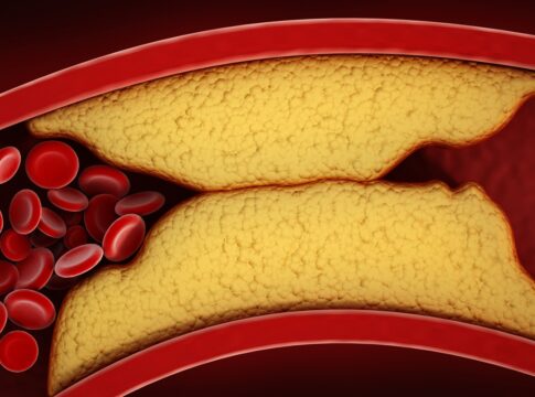 medico-vascular-aponta-o-que-ajuda-a-reduzir-a-gordura-nas-arterias