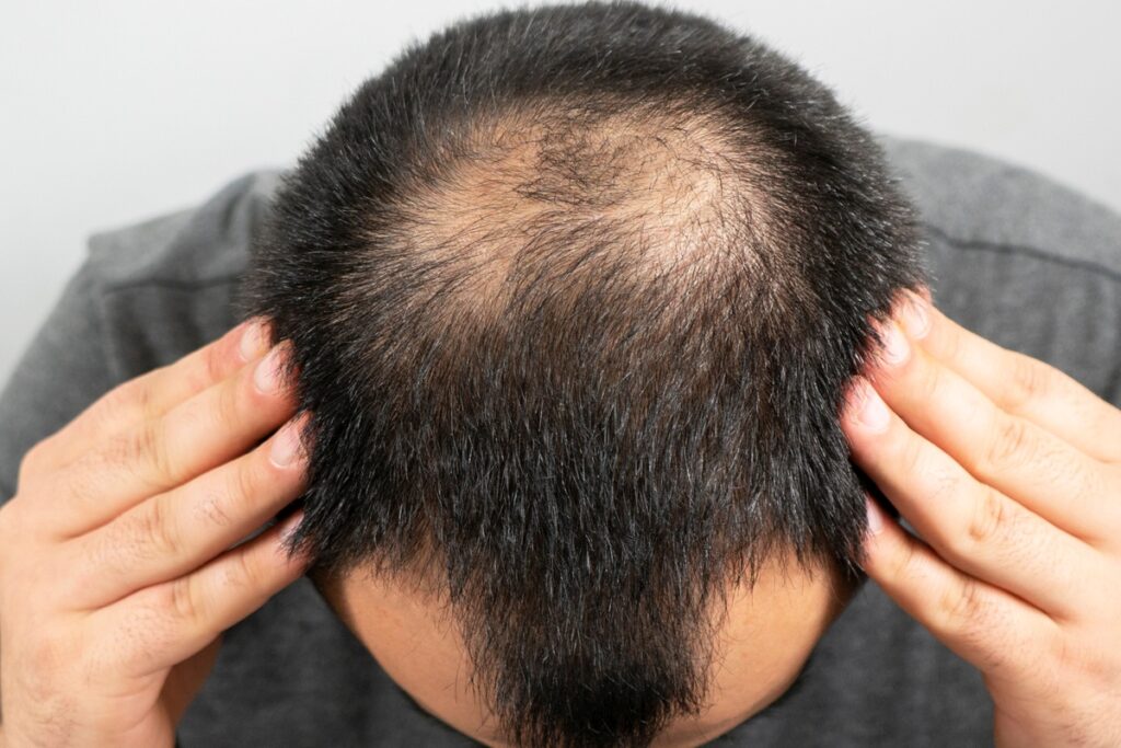 estudo-chines-encontra-propriedade-em-planta-para-tratar-calvicie