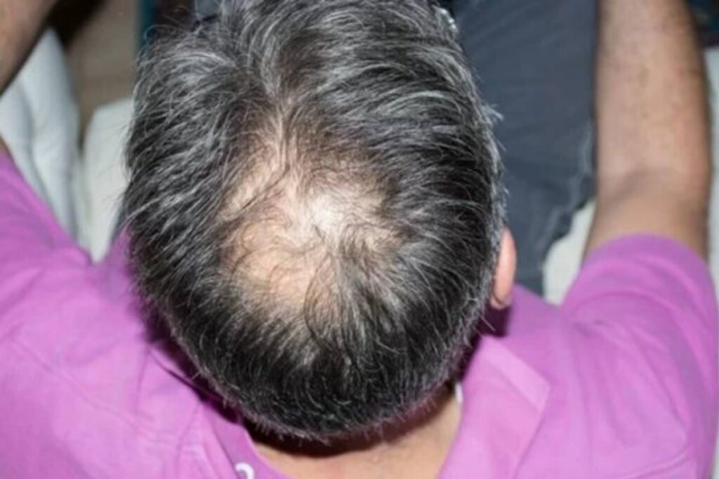 adeus,-minoxidil:-conheca-novos-tratamentos-contra-a-calvicie