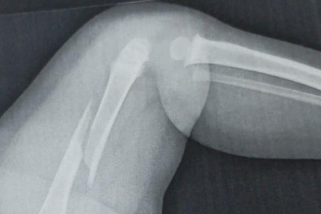 policia-investiga-fratura-de-femur-em-crianca-de-1-ano-e-5-meses-no-pr