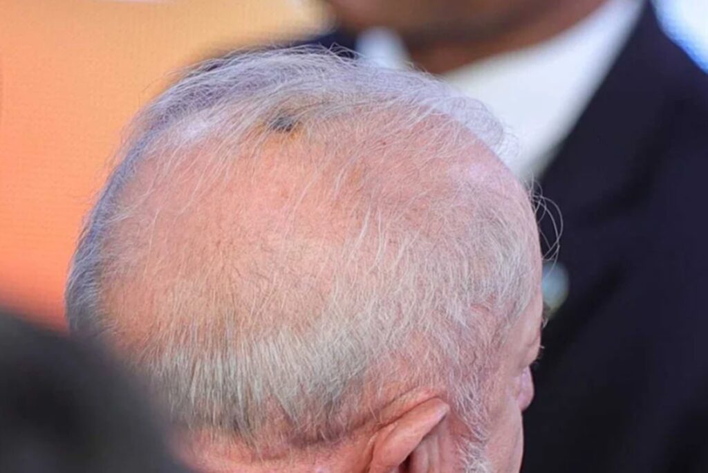 queratose:-dermatologistas-explicam-sinal-retirado-por-lula