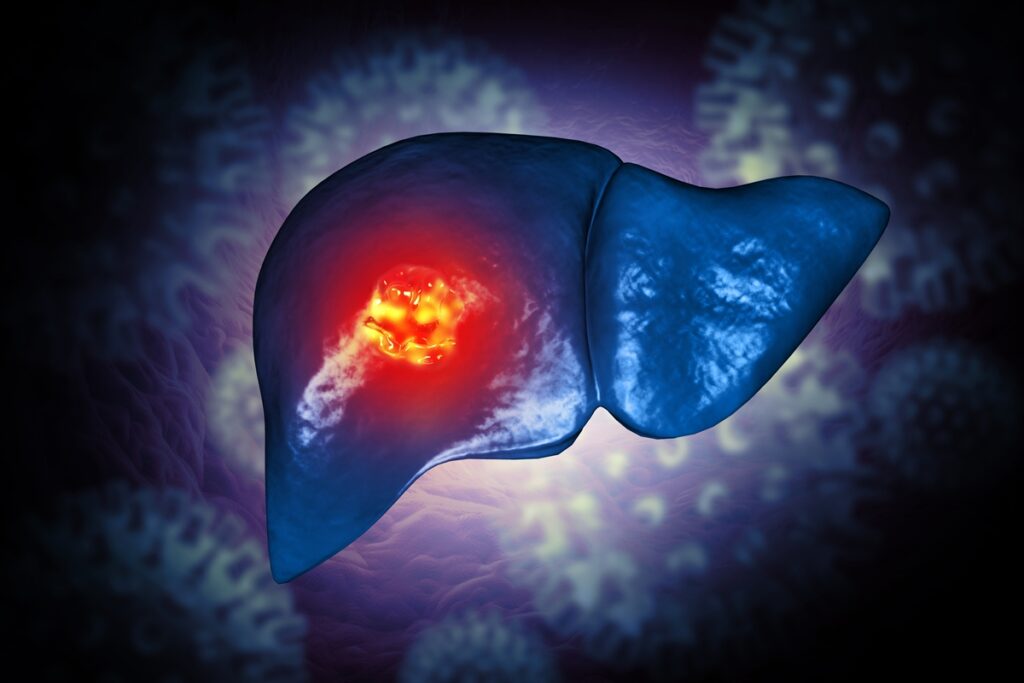 oncologista-indica-quais-sao-os-sintomas-iniciais-de-cancer-no-figado