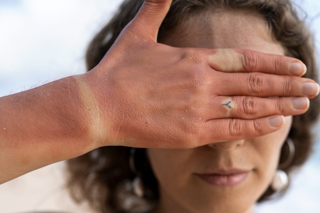 protetor-solar-nao-evita-insolacao.-dermatologista-ensina-como-se-proteger