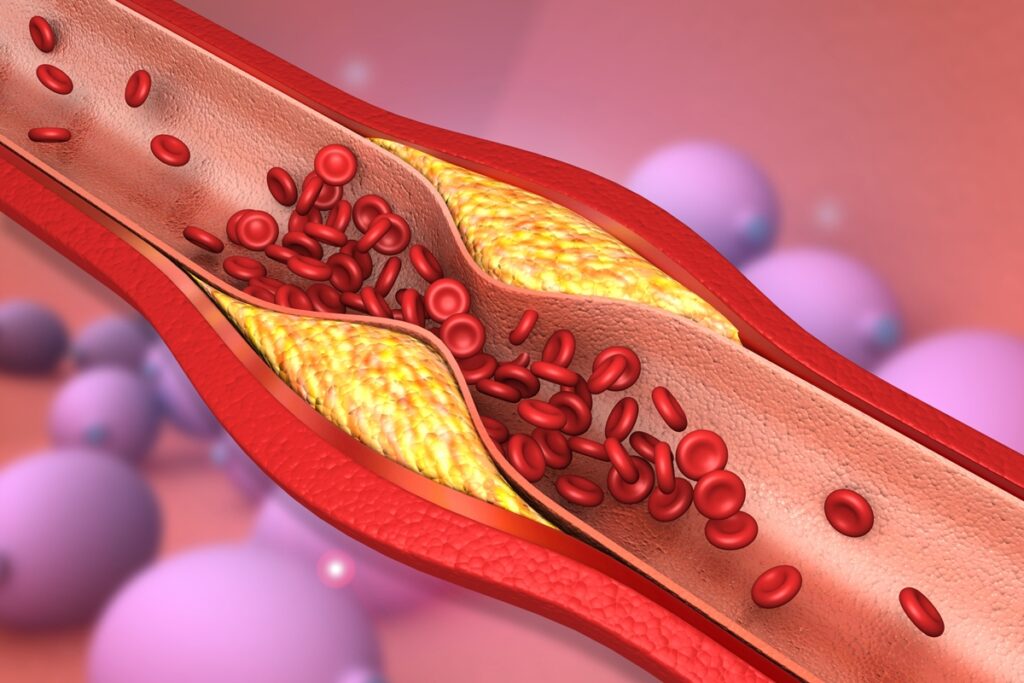 cardiologista-aponta-2-habitos-que-mais-deixam-as-arterias-“entupidas”
