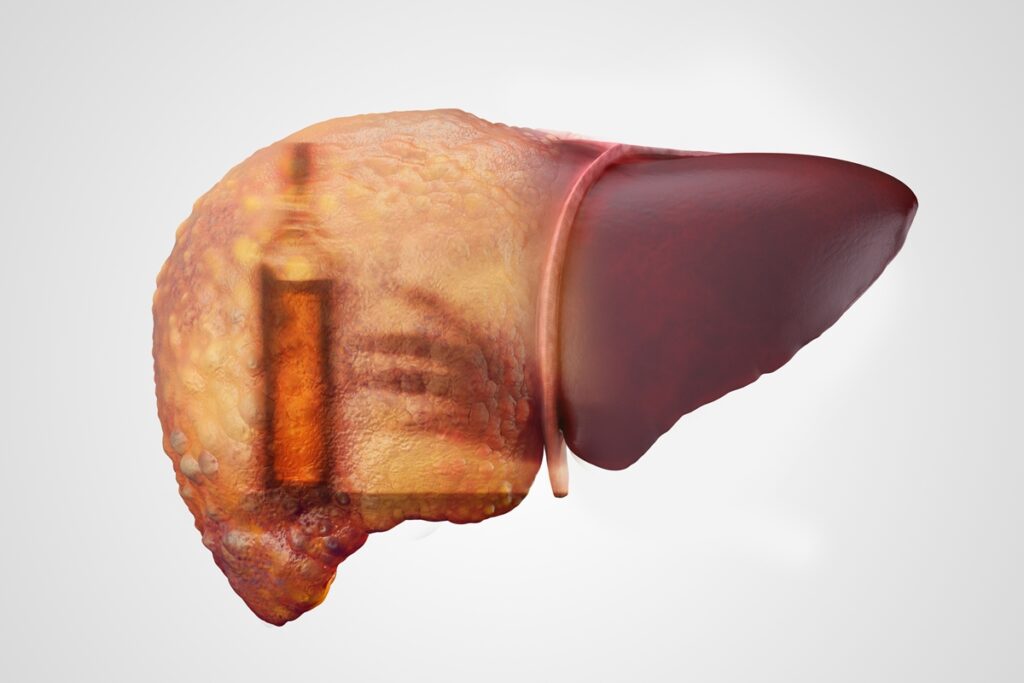 hepatologista-revela-se-existe-algo-que-“elimina”-o-alcool-do-figado